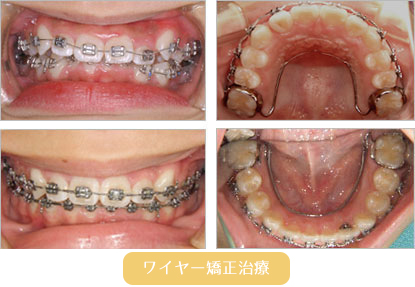 ワイヤー矯正治療