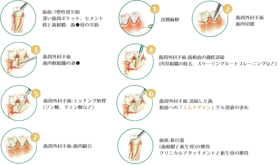 歯周外科処置? | つくば市の大久保歯科医院 歯周外科処置? | つくば市の大久保歯科医院